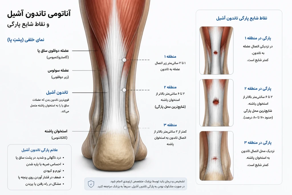 درمان جراحی یا غیرجراحی پارگی تاندون آشیل | راهنمای جامع انتخاب بهترین روش ترمیم