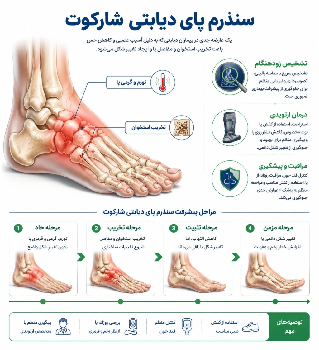 سندرم پای دیابتی شارکوت | بررسی مراحل و روش‌های نوین درمان