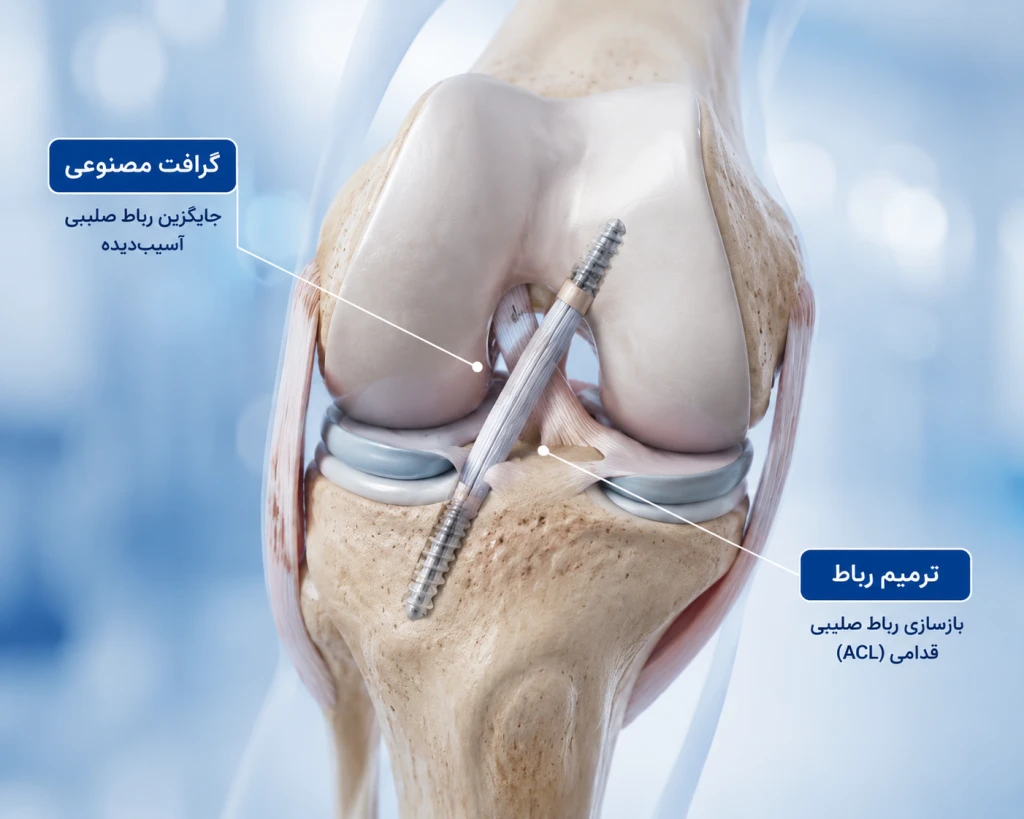 استفاده از گرافتهای مصنوعی در بازسازی رباط | بررسی مزایا، معایب و نتایج بلندمدت