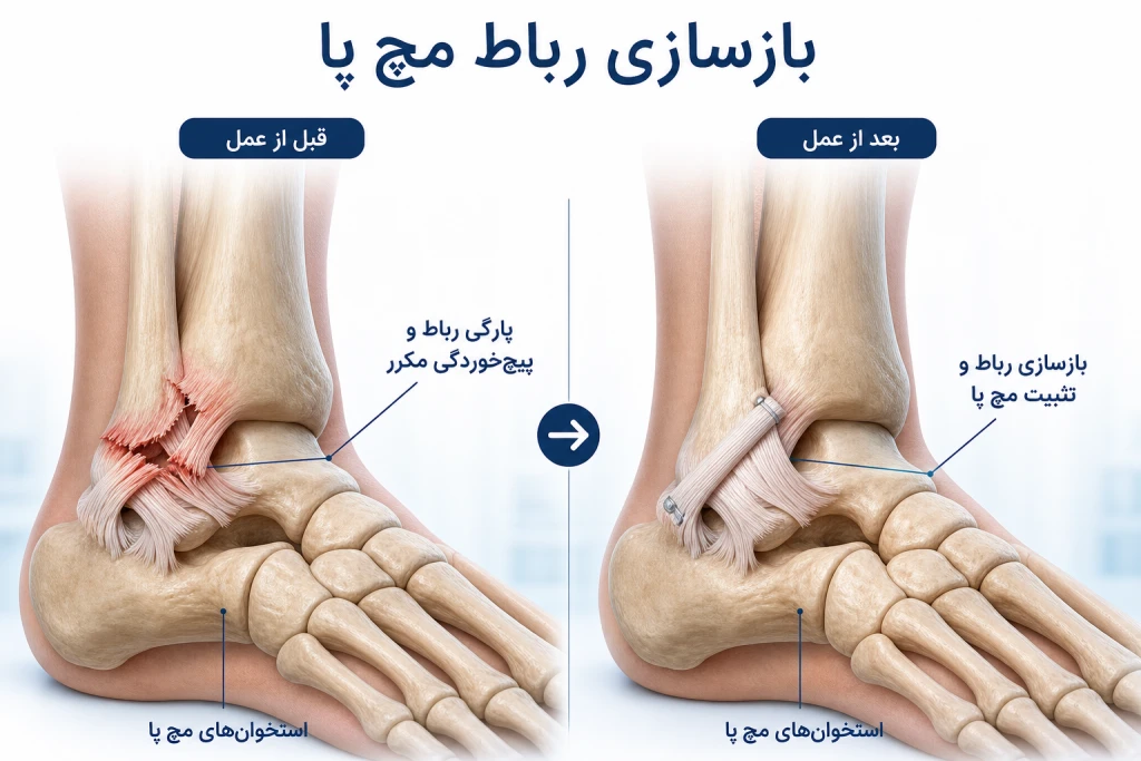 بازسازی رباط مچ پا چگونه پیچ خوردگی‌های مکرر را درمان می‌کند؟