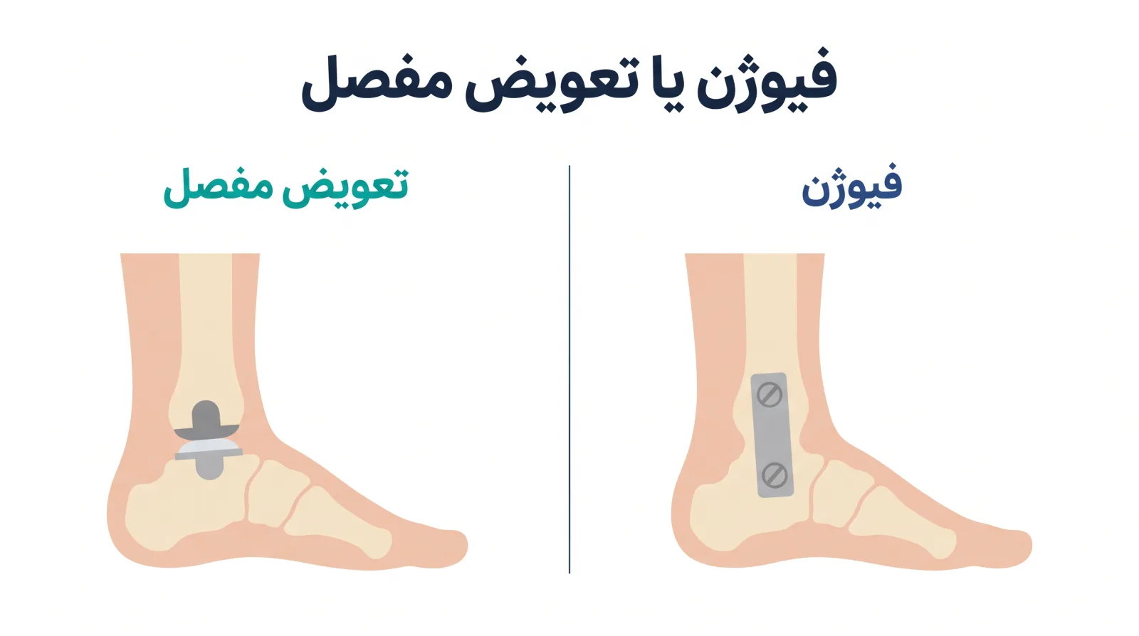 طرح مقایسه‌ای فیوژن مچ پا با پیچ و پلاک در برابر تعویض مفصل مچ پا با پروتز