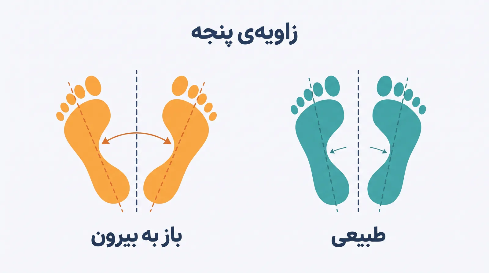 اینفوگرافیک مقایسه‌ی زاویه‌ی طبیعی پنجه و پای باز به بیرون هنگام راه‌رفتن