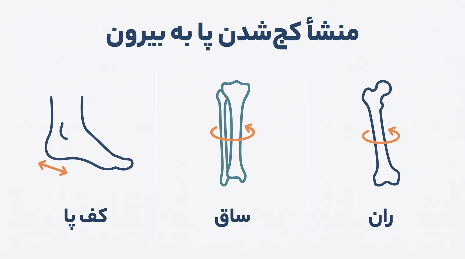 پوستر مقایسه‌ی منشأ کج‌شدن پا به بیرون از ران، ساق و کف پا